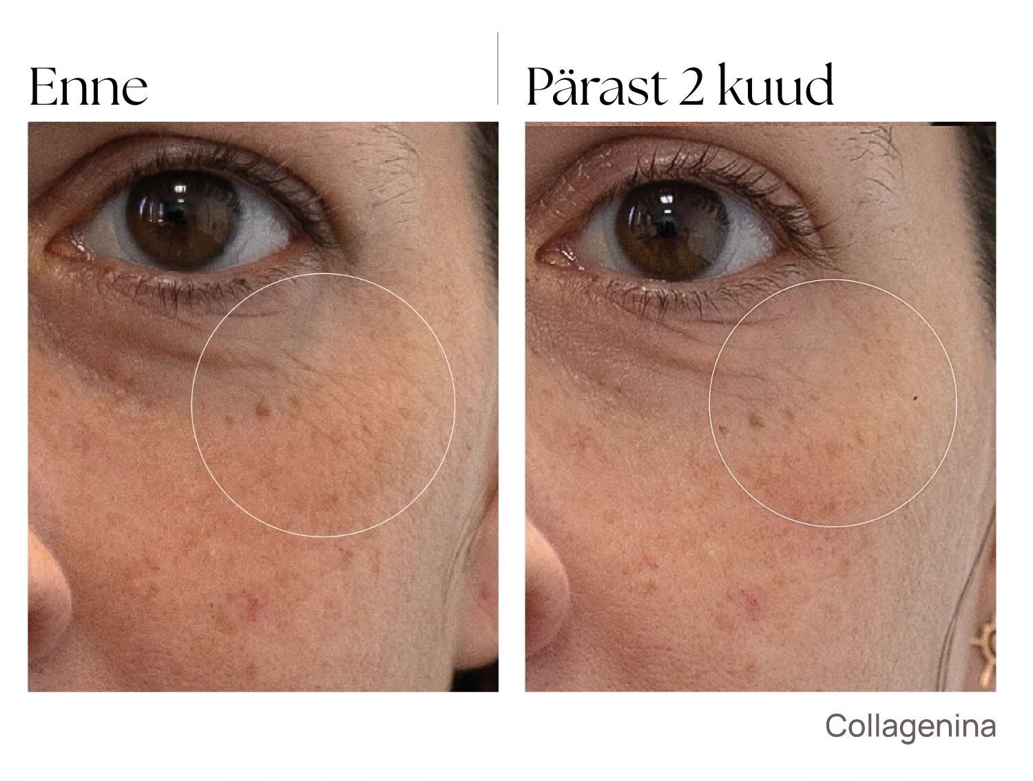 collagenina_seerum_tulemused_enne_parast